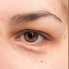 Dark Circles & Puffiness